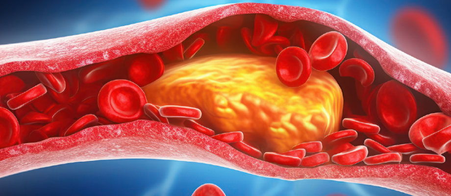 Why High Cholesterol Is a Risk Factor for Cardiovascular Diseases and How to Lower It